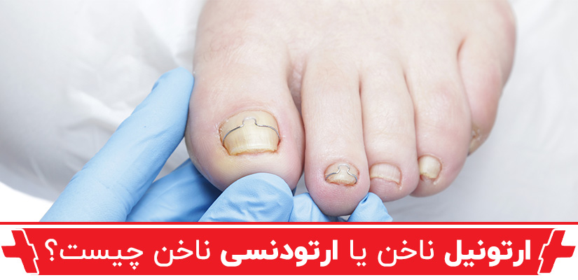 ارتونیل ناخن یا ارتودنسی ناخن
