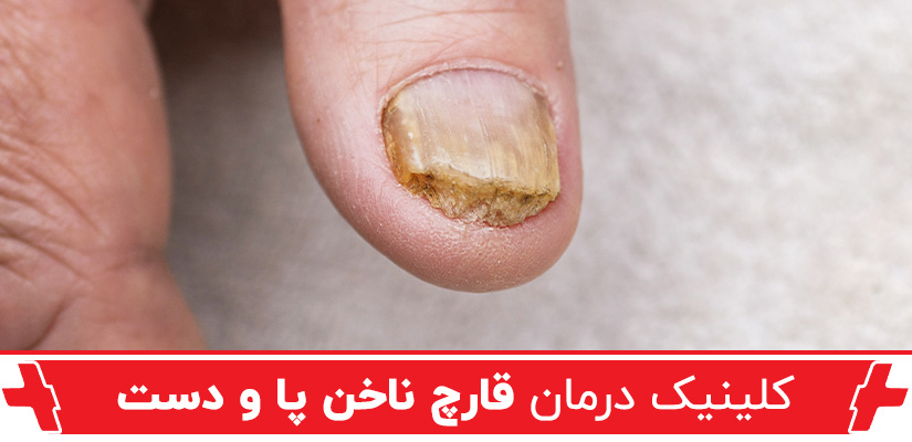 کلینیک درمان قارچ ناخن
